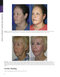 The Art and Science of Facelift Surgery 2nd Edition 2024