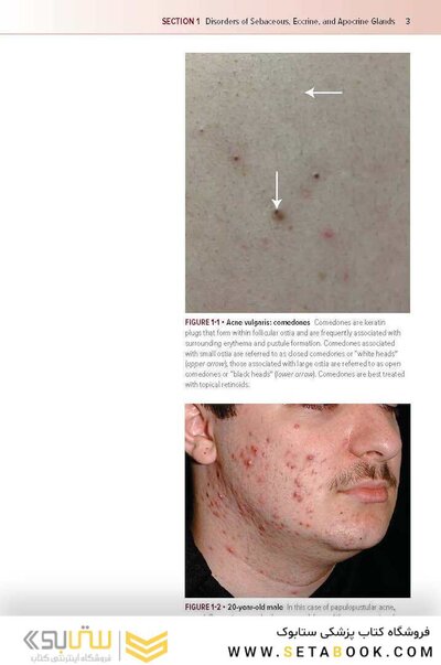 Fitzpatrick's Color Atlas and Synopsis of Clinical Dermatology, Ninth Edition 2024