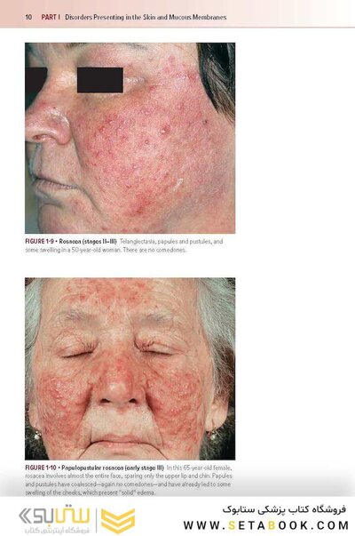 Fitzpatrick's Color Atlas and Synopsis of Clinical Dermatology, Ninth Edition 2024