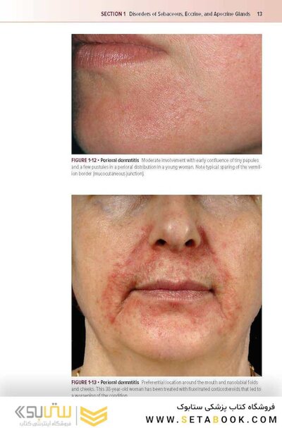 Fitzpatrick's Color Atlas and Synopsis of Clinical Dermatology, Ninth Edition 2024