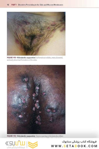 Fitzpatrick's Color Atlas and Synopsis of Clinical Dermatology, Ninth Edition 2024