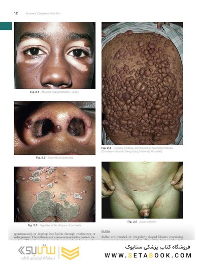 Andrews' Diseases of the Skin: Clinical Dermatology, 14th Edition