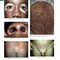 Andrews' Diseases of the Skin: Clinical Dermatology, 14th Edition