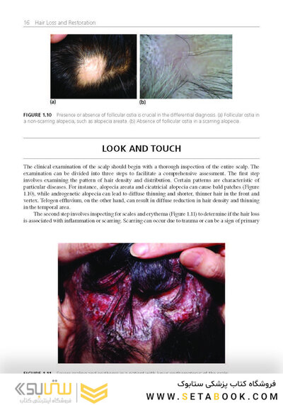 Hair Loss and Restoration 3rd Edition