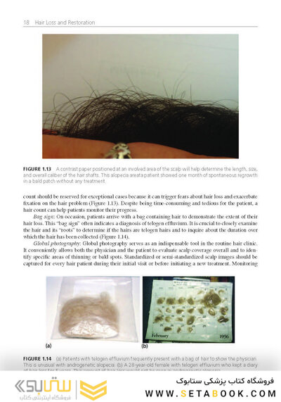 Hair Loss and Restoration 3rd Edition