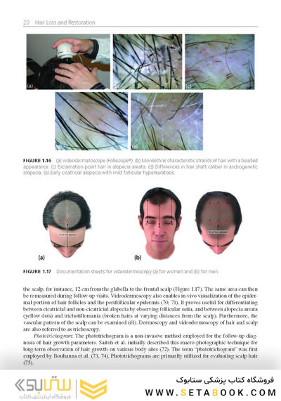 Hair Loss and Restoration 3rd Edition