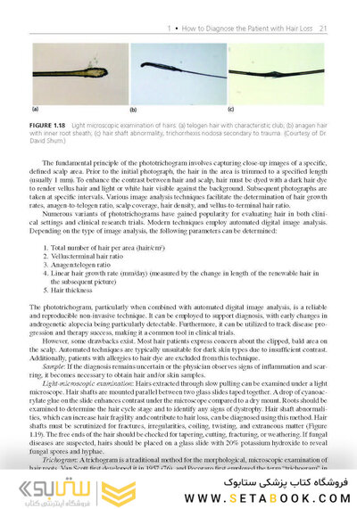 Hair Loss and Restoration 3rd Edition