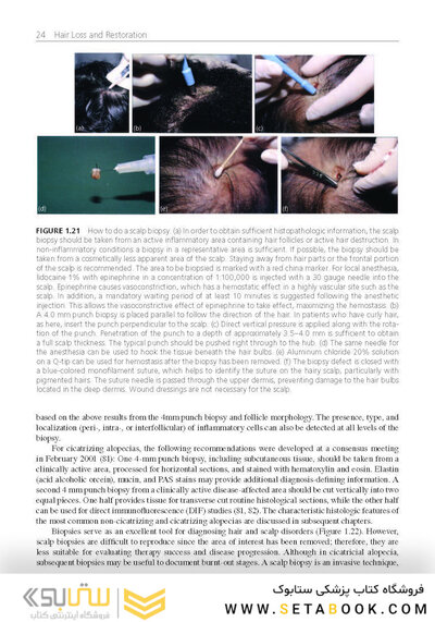 Hair Loss and Restoration 3rd Edition