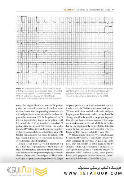 Cardiac Pacing and ICDs
