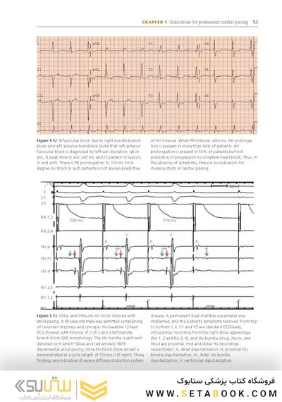 Cardiac Pacing and ICDs