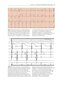 Cardiac Pacing and ICDs