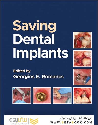 Saving Dental Implants 1st Edition