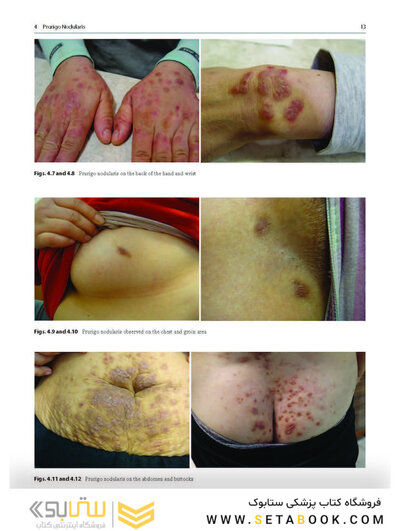 Dermatology Diaries: An Illustrated Guide to Common Skin Diseases