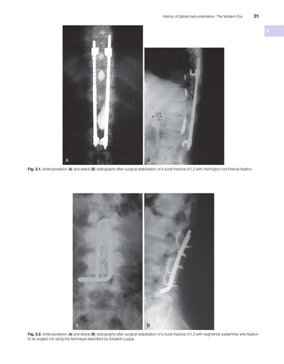 Benzel’s Spine Surgery 5th Edition 2022