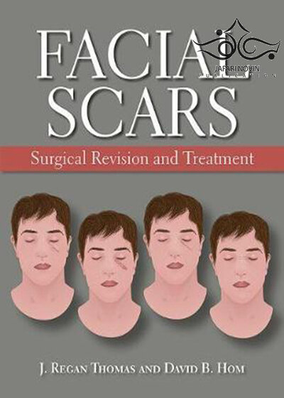 Facial Scars: Surgical Revision and Treatment2017