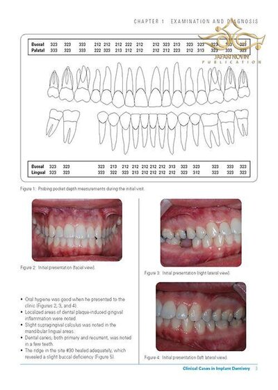 Clinical Cases in Implant Dentistry