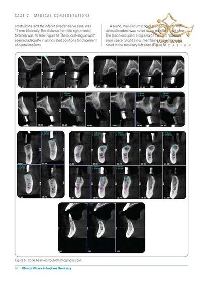 Clinical Cases in Implant Dentistry