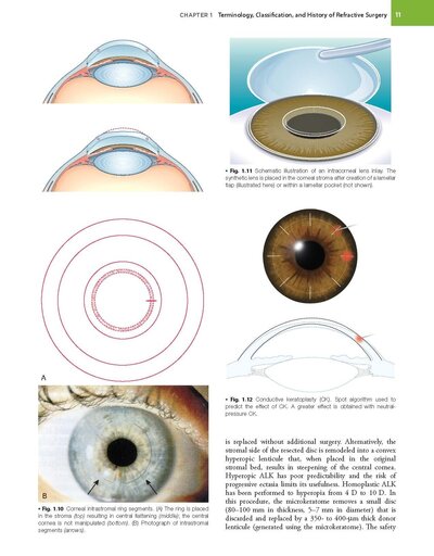 Refractive Surgery, 3rd Edition2019