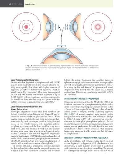 Refractive Surgery, 3rd Edition2019