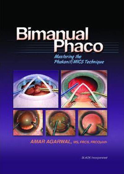 Bimanual Phaco: Mastering the Phakonit/MICS Technique2004