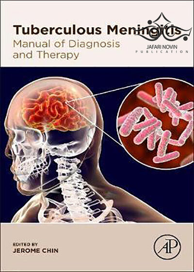 Tuberculous-Meningitis2020 مننژیت سل