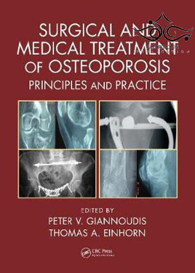 Surgical and Medical Treatment of Osteoporosis: Principles and Practice 1st Edition درمان جراحی و پزشکی پوکی استخوان: اصول و عمل