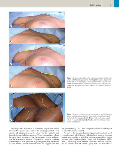 Plastic Surgery Neligan Volume 5: Breast 5th Edition 2023