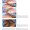 Plastic Surgery Neligan Volume 5: Breast 5th Edition 2023