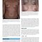 Plastic Surgery Neligan Volume 5: Breast 5th Edition 2023