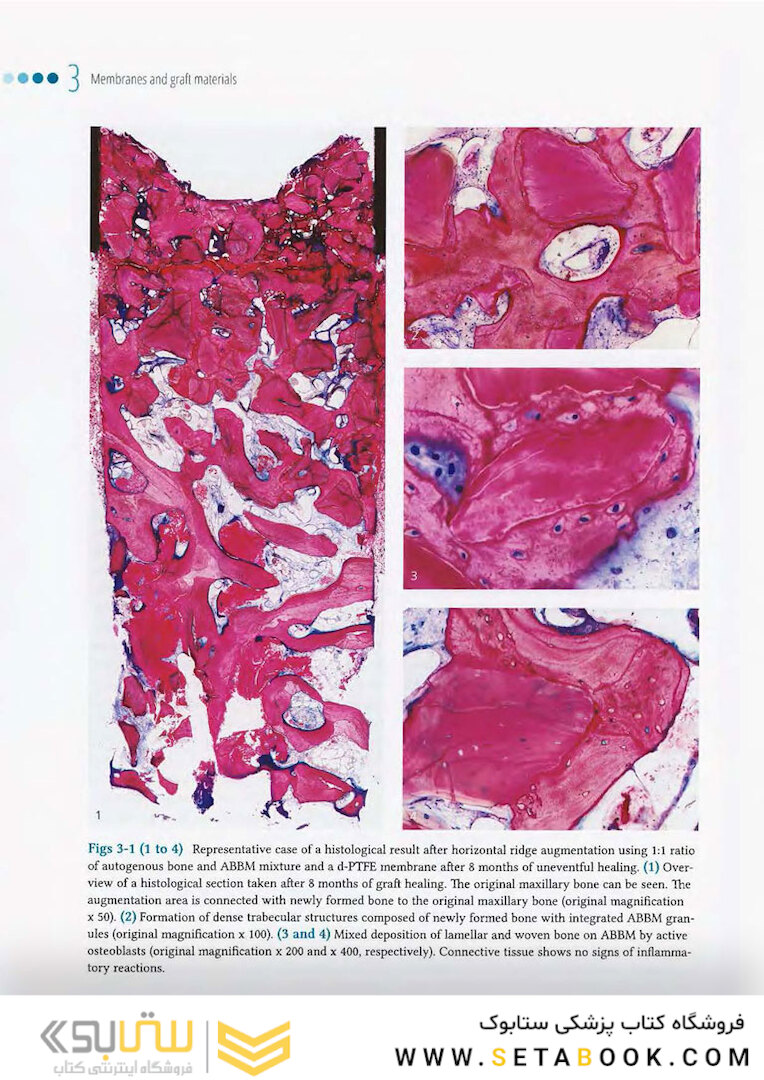 Vertical and Horizontal Ridge Augmentation