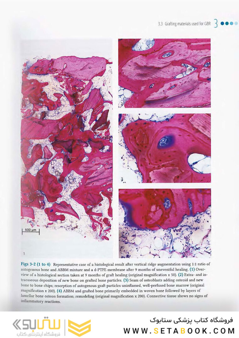 Vertical and Horizontal Ridge Augmentation