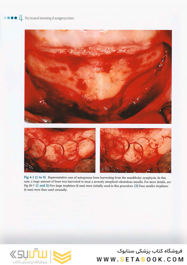 Vertical and Horizontal Ridge Augmentation