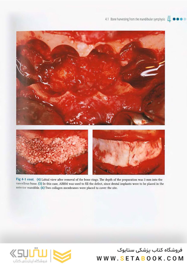 Vertical and Horizontal Ridge Augmentation