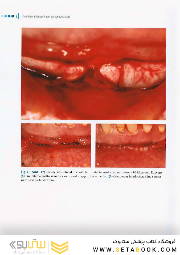 Vertical and Horizontal Ridge Augmentation