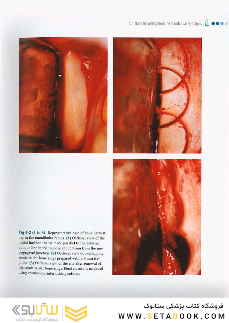 Vertical and Horizontal Ridge Augmentation