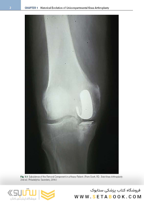 Unicompartmental Knee Arthroplasty