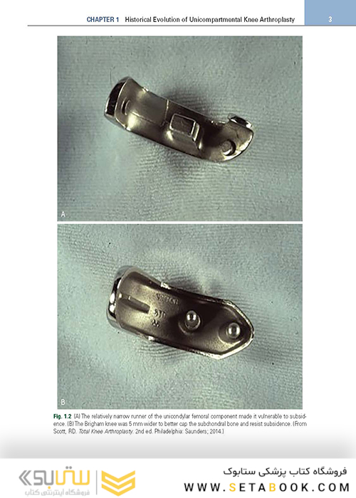 Unicompartmental Knee Arthroplasty