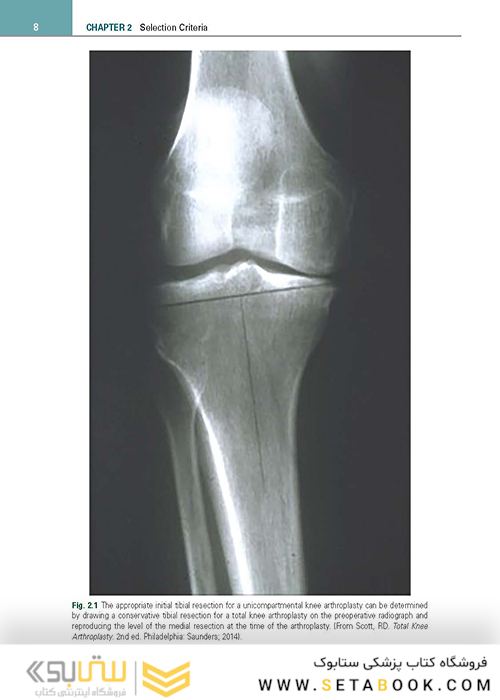Unicompartmental Knee Arthroplasty