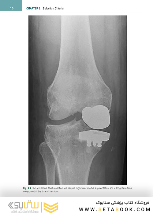 Unicompartmental Knee Arthroplasty