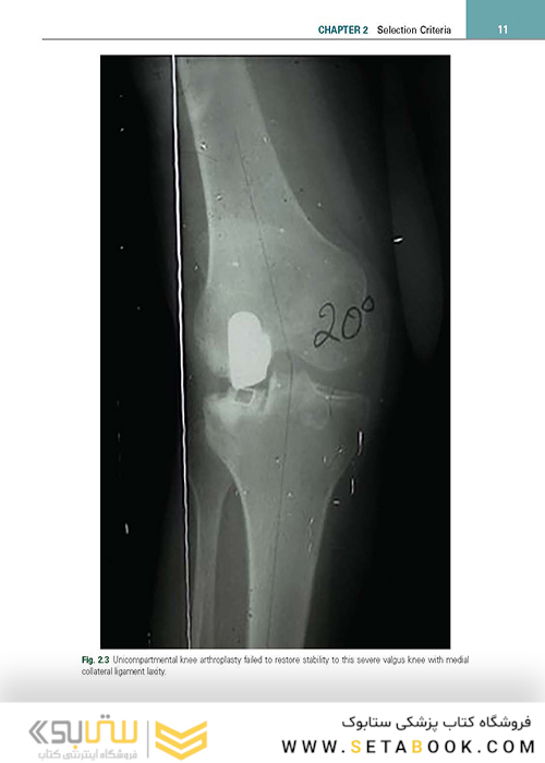 Unicompartmental Knee Arthroplasty