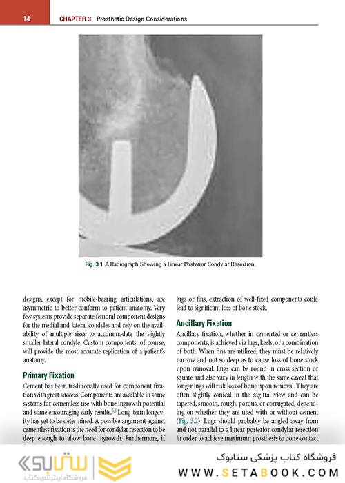 Unicompartmental Knee Arthroplasty