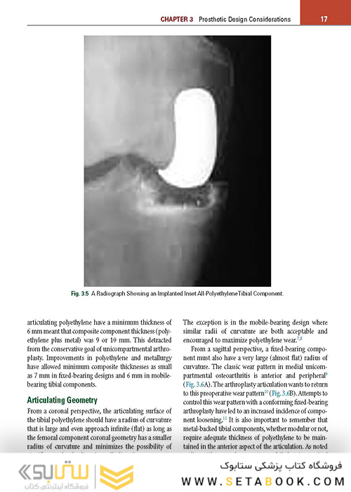 Unicompartmental Knee Arthroplasty