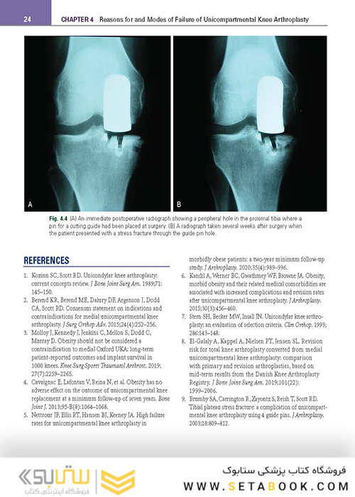 Unicompartmental Knee Arthroplasty