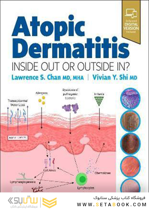 Atopic Dermatitis: Inside Out or Outside In