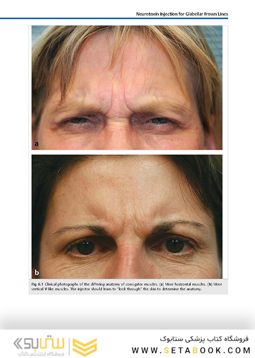 Cosmetic Injection Techniques : A Text and Video Guide to Neurotoxins and Fillers