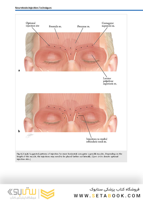 Cosmetic Injection Techniques : A Text and Video Guide to Neurotoxins and Fillers