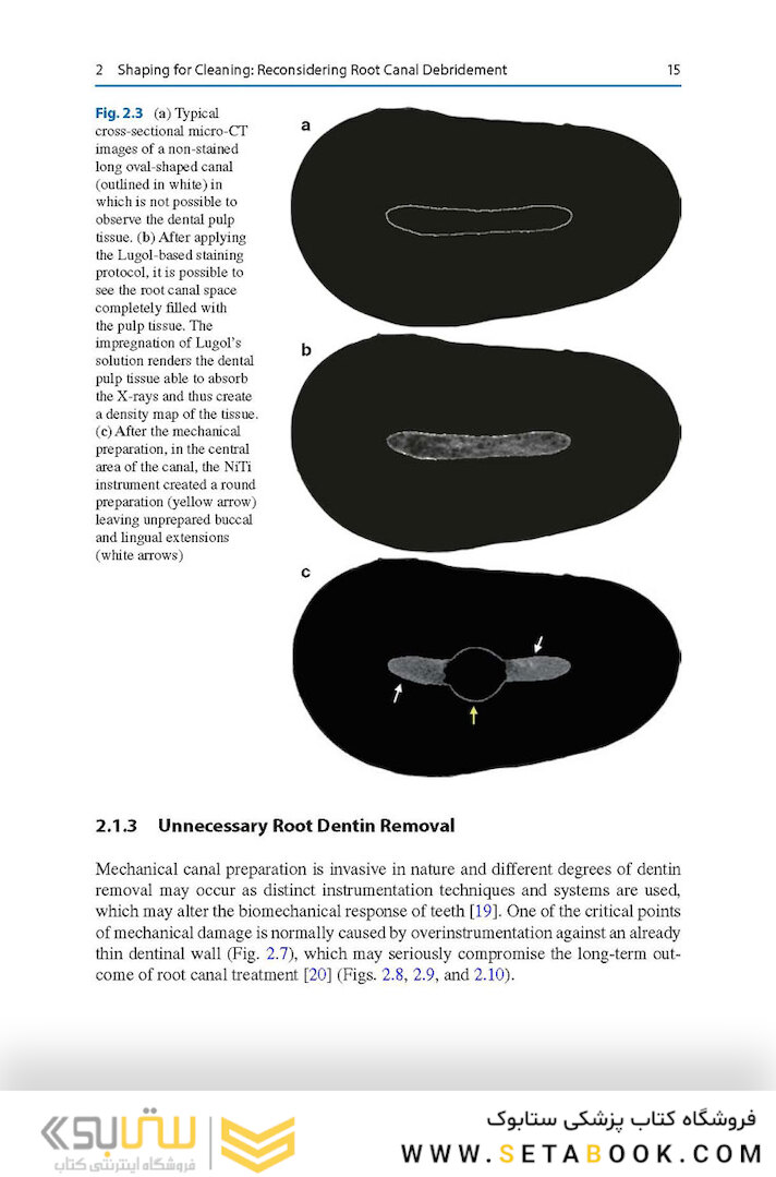 Shaping for Cleaning the Root Canals : A Clinical-Based Strategy 2022