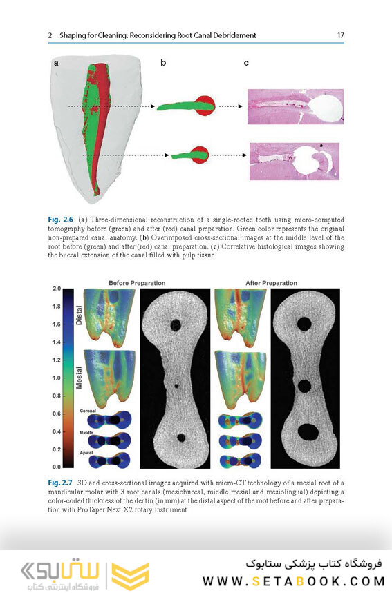 Shaping for Cleaning the Root Canals : A Clinical-Based Strategy 2022