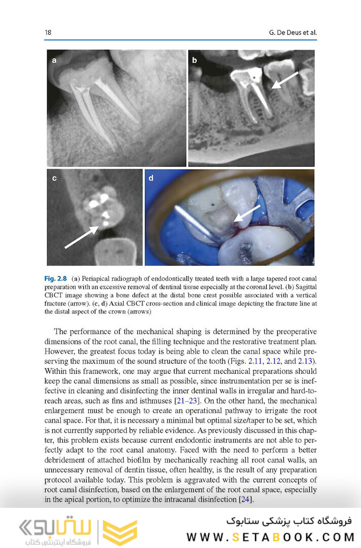 Shaping for Cleaning the Root Canals : A Clinical-Based Strategy 2022