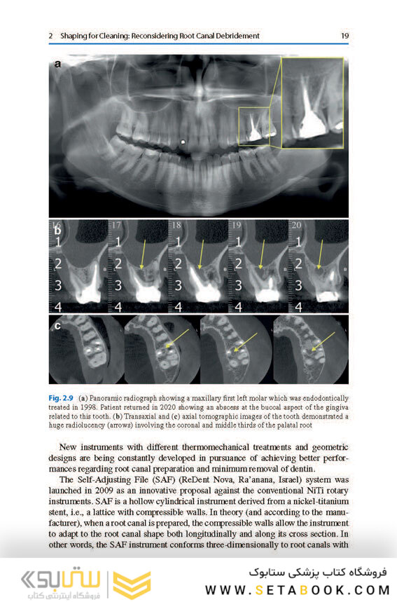 Shaping for Cleaning the Root Canals : A Clinical-Based Strategy 2022